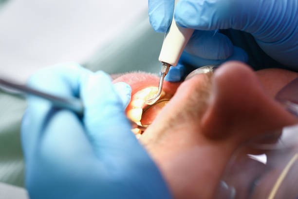 Best Emergency Root Canal Treatment in Bronson, MI