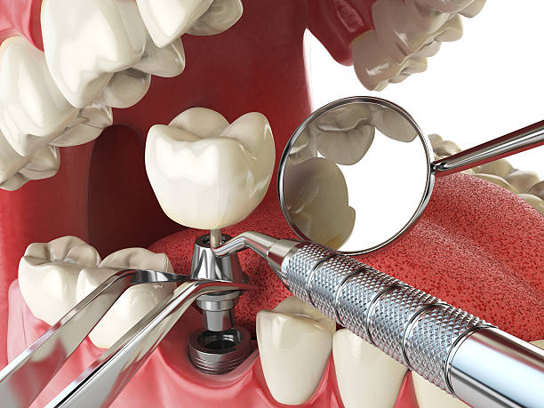 Best Emergency Tooth Extraction in Bronson, MI